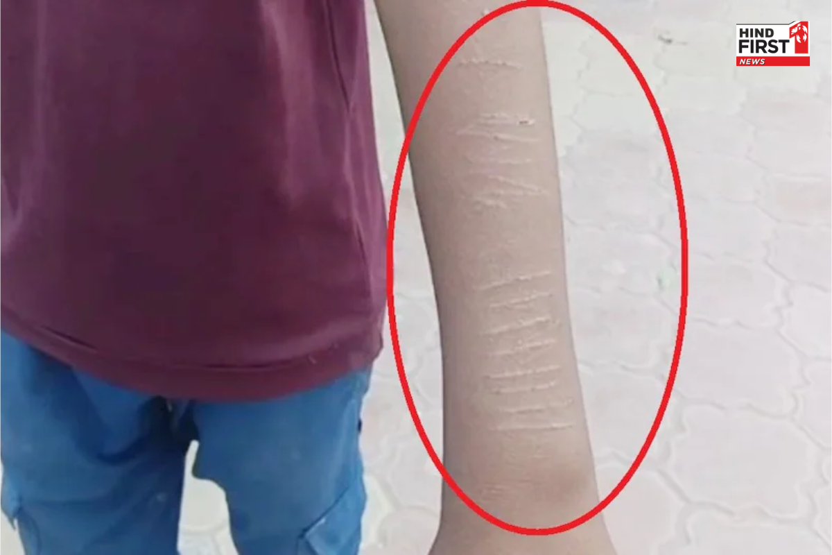 Gujarat News: स्कूल में खतरनाक खेल ने बच्चों को पहुंचाया अस्पताल, 25 से ज्यादा छात्रों के हाथों पर ब्लेड के निशान Gujarat News: स्कूल में खतरनाक खेल ने बच्चों को पहुंचाया अस्पताल, 25 से ज्यादा छात्रों के हाथों पर ब्लेड के निशान