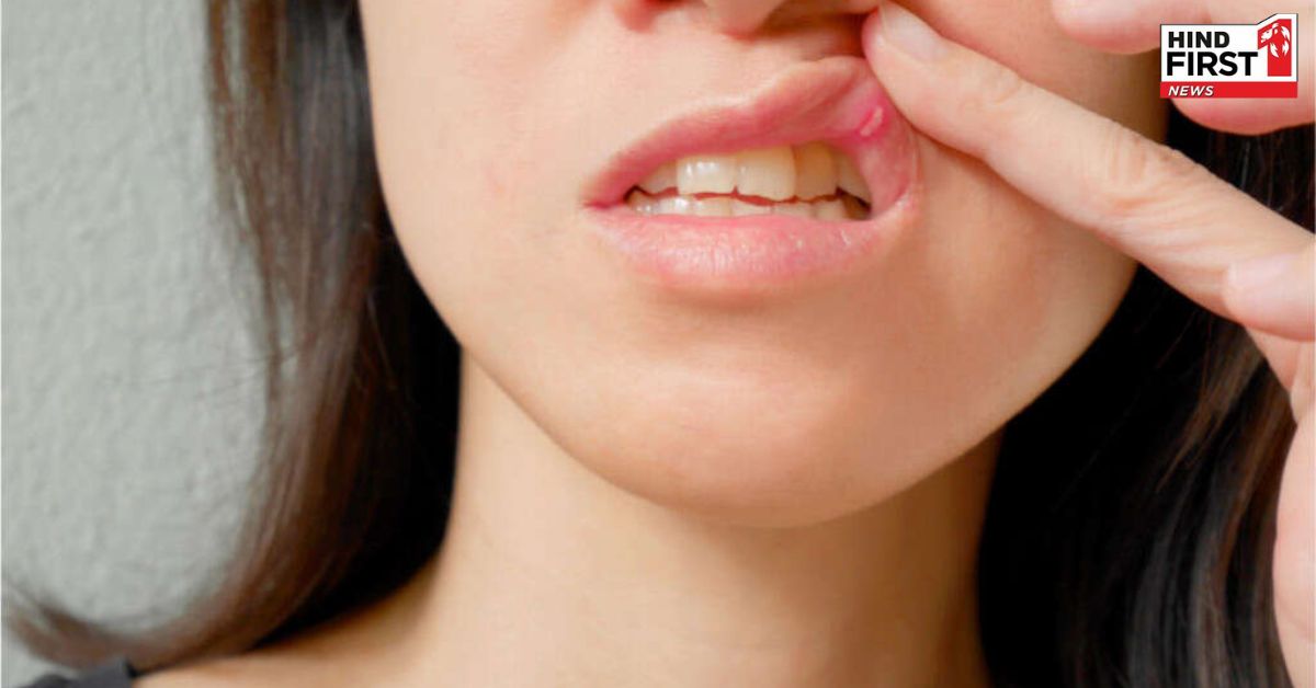 क्या आपको पता है बार-बार क्यों होते हैं मुंह के छालें, जाने इसके मुख्य कारण