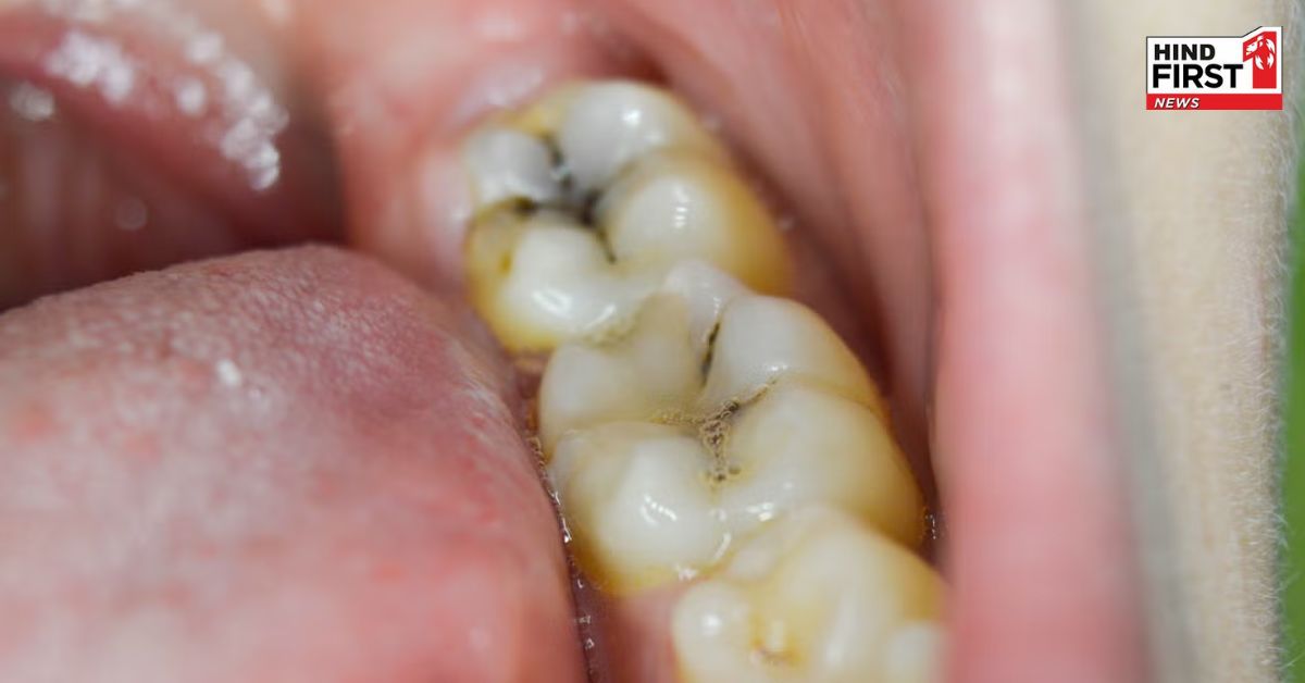 दांतों की कैविटी से पाना है छुटकारा तो ये घरेलु नुस्खे हैं बेहद कारगर