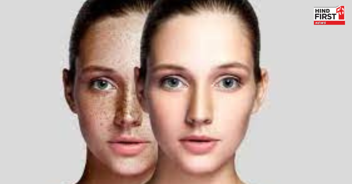 पिगमेंटेशन या काले धब्बों ने खूबसूरती पर लगा दिया है ग्रहण, तो इन उपायों से पाएं निजात