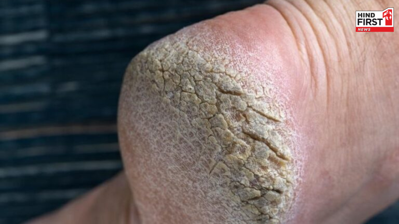Cracked Heels Remedies: फटी एड़ियों से हैं परेशान, ये पांच घरेलु इलाज दिलाएंगे आराम