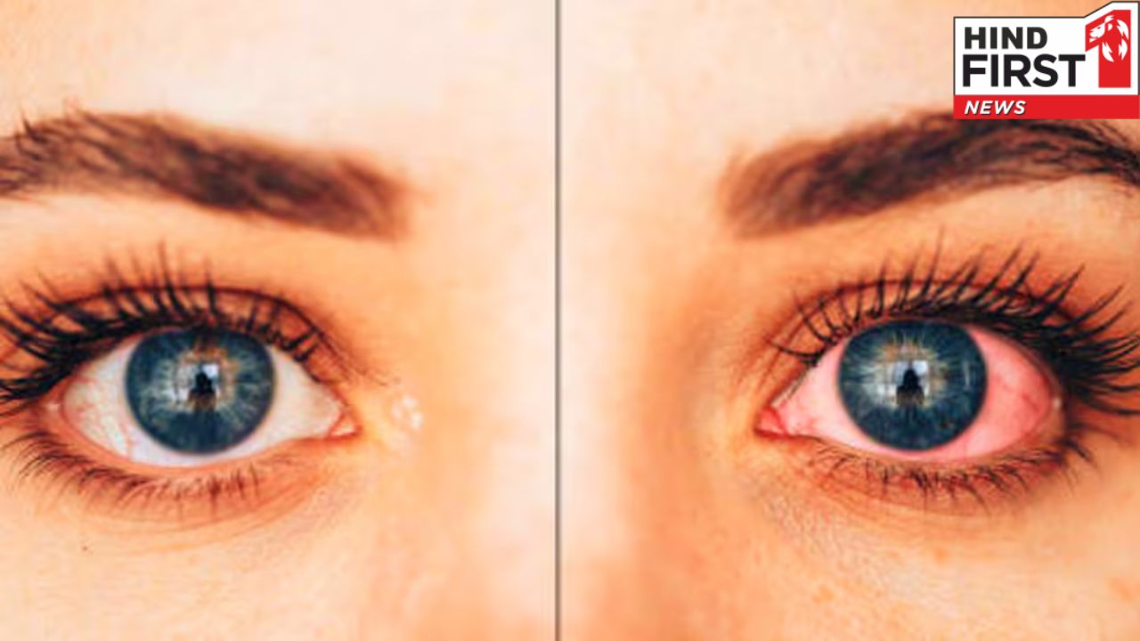 बारिश में आई फ्लू होने का है ज्यादा डर, जानिए इसके लक्षण और बचाव के उपाय