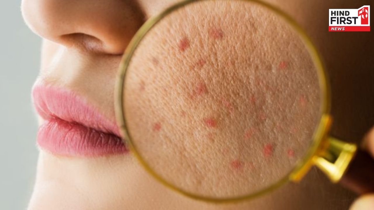 Pimples Home Remedies: गर्मियों में हैं मुंहासे से परेशान, अपनाएं ये पांच घरेलू उपाय Pimples Home Remedies: गर्मियों में हैं मुंहासे से परेशान, अपनाएं ये पांच घरेलू उपाय