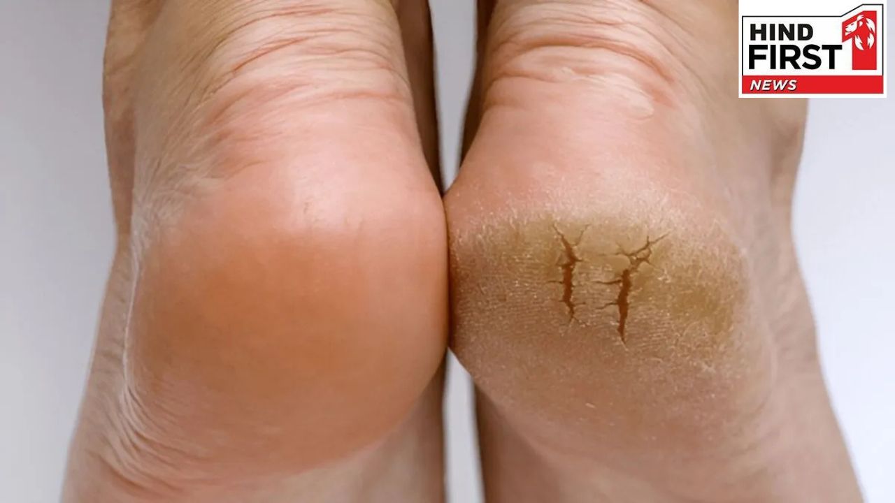 Crack Heel Care: फटी एड़ियों से हैं परेशान तो रोज रात में जरूर करें ये काम, बनेंगे चिकने और मुलायम